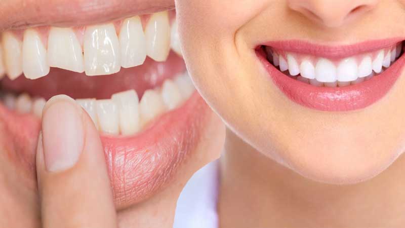 Cosmetic Dentistry as Birthday or Christmas Gifts: Do People Give It?