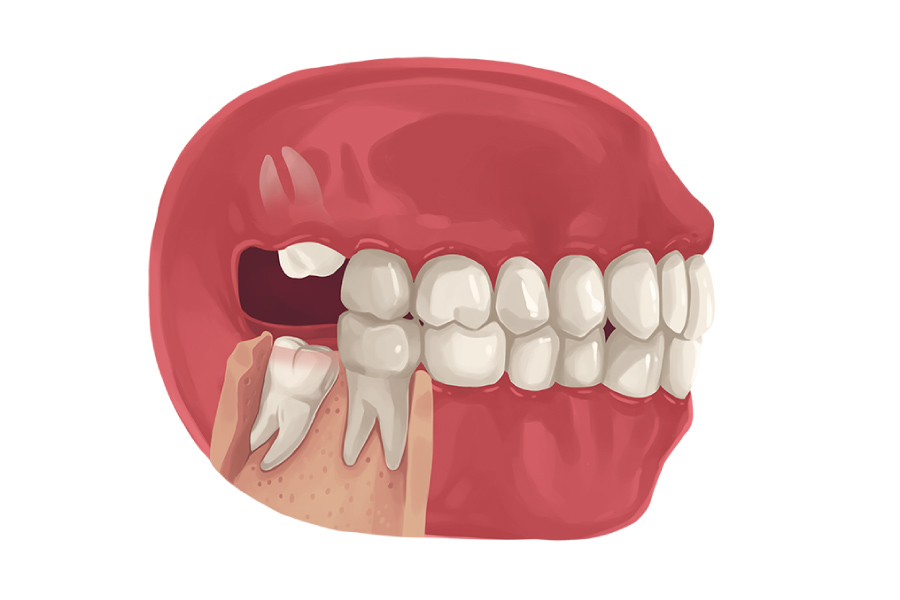 Wisdom Teeth: Unveiling the Myths, Facts, and Extraction Insights