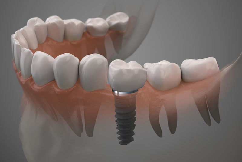 Titanium dental implants