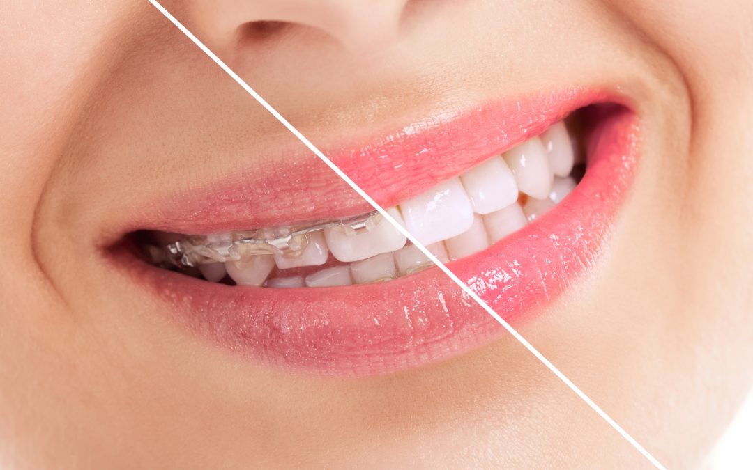 The Impact of Cosmetic Dentistry on Oral Health: More Than Just Looks