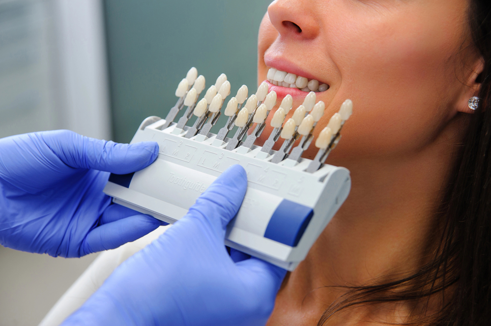 Veneers