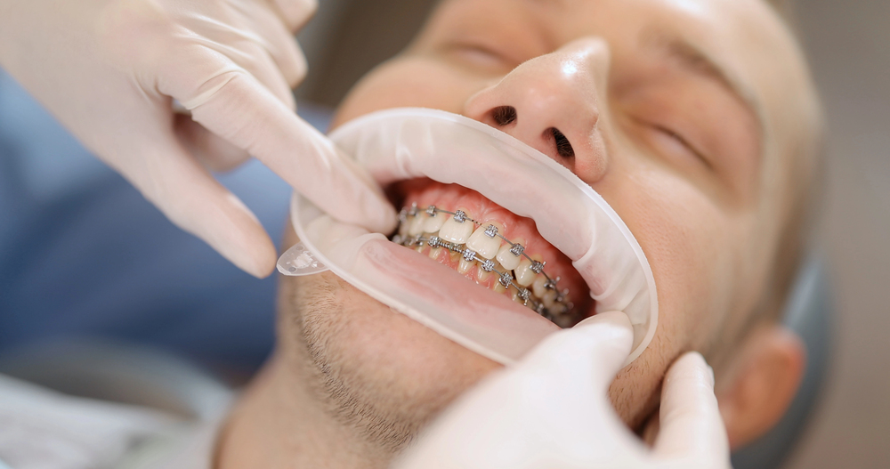 Biomimicry in Orthodontics: Learning from Nature to Perfect Alignment