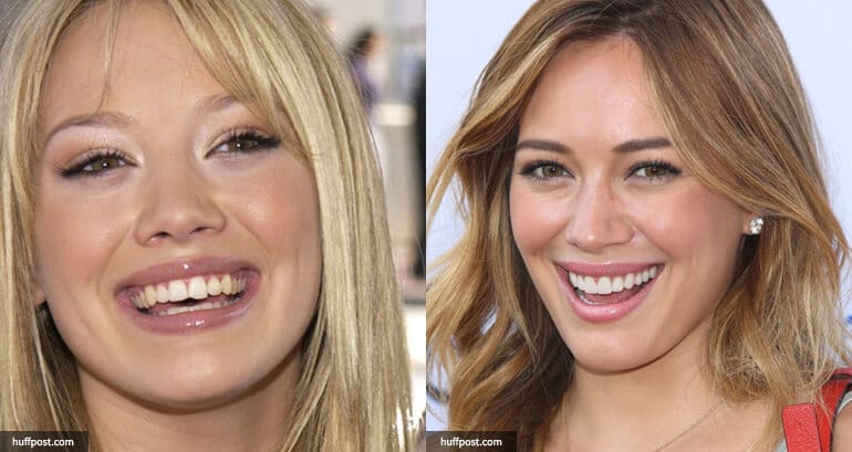 Why Dental Crowns Are Becoming Fashion Statements in Celebrity Culture